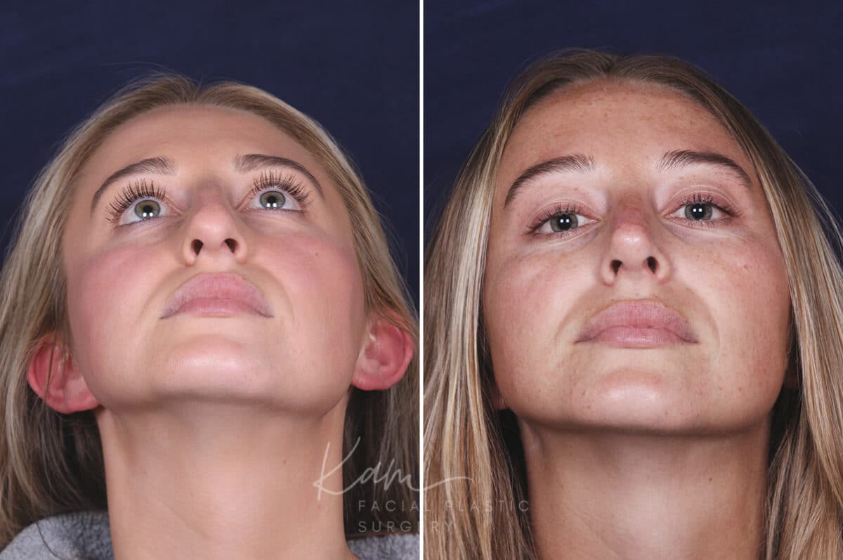 Rhinoplasty before and after photos in Voorhees, NJ, Patient 121