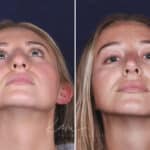 Rhinoplasty before and after photos in Voorhees, NJ, Patient 121