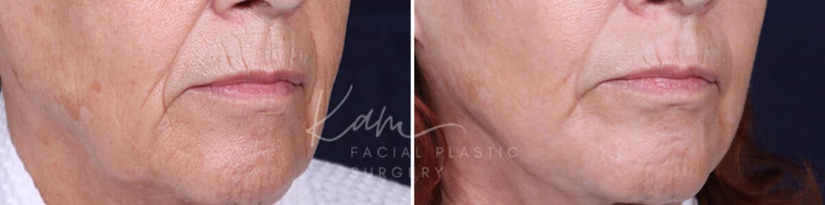 Laser Resurfacing before and after photos in Voorhees, NJ, Patient 1220