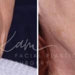 Laser Resurfacing before and after photos in Voorhees, NJ, Patient 1220