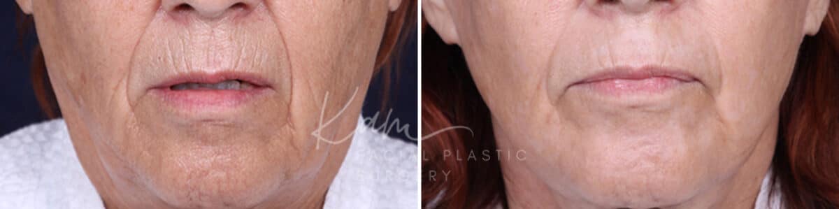 Laser Resurfacing before and after photos in Voorhees, NJ, Patient 1220