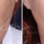 Laser Resurfacing before and after photos in Voorhees, NJ, Patient 1220