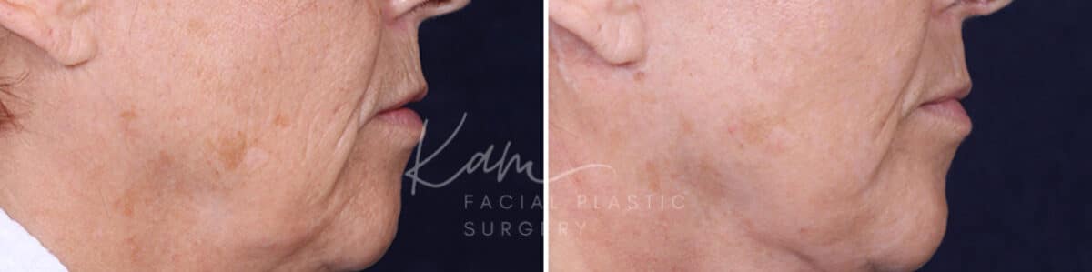 Laser Resurfacing before and after photos in Voorhees, NJ, Patient 1220
