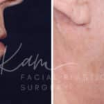 Laser Resurfacing before and after photos in Voorhees, NJ, Patient 1220