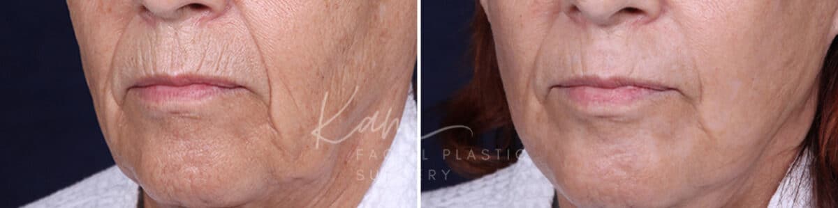 Laser Resurfacing before and after photos in Voorhees, NJ, Patient 1220