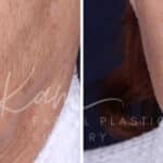 Laser Resurfacing before and after photos in Voorhees, NJ, Patient 1220