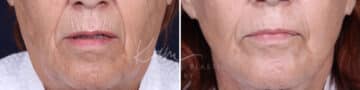 Laser Resurfacing before and after photos in Voorhees, NJ, Patient 1220