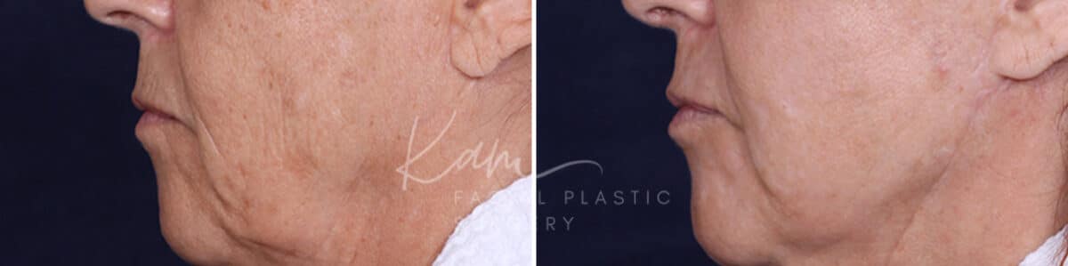 Laser Resurfacing before and after photos in Voorhees, NJ, Patient 1220