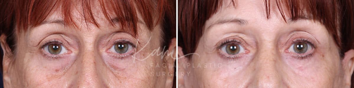 Laser Resurfacing before and after photos in Voorhees, NJ, Patient 1220