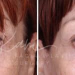 Laser Resurfacing before and after photos in Voorhees, NJ, Patient 1220