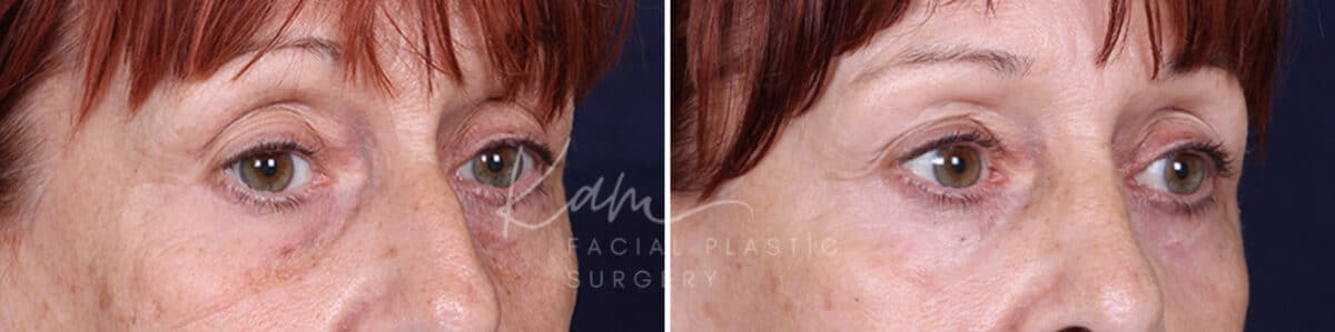 Laser Resurfacing before and after photos in Voorhees, NJ, Patient 1220
