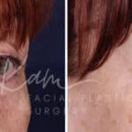 Laser Resurfacing before and after photos in Voorhees, NJ, Patient 1220