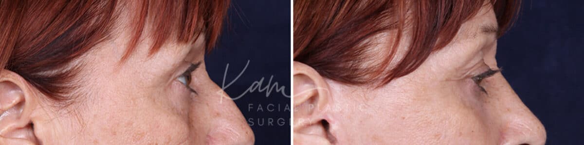Laser Resurfacing before and after photos in Voorhees, NJ, Patient 1220