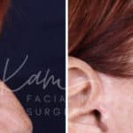 Laser Resurfacing before and after photos in Voorhees, NJ, Patient 1220