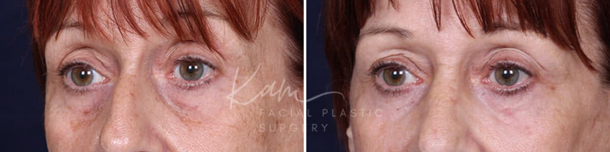 Laser Resurfacing before and after photos in Voorhees, NJ, Patient 1220