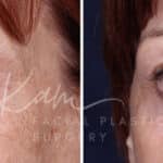 Laser Resurfacing before and after photos in Voorhees, NJ, Patient 1220