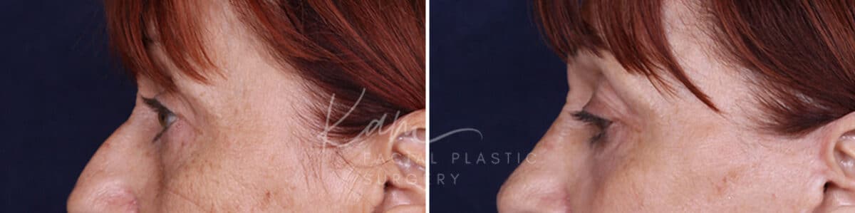 Laser Resurfacing before and after photos in Voorhees, NJ, Patient 1220
