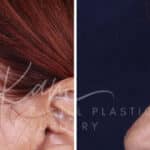 Laser Resurfacing before and after photos in Voorhees, NJ, Patient 1220