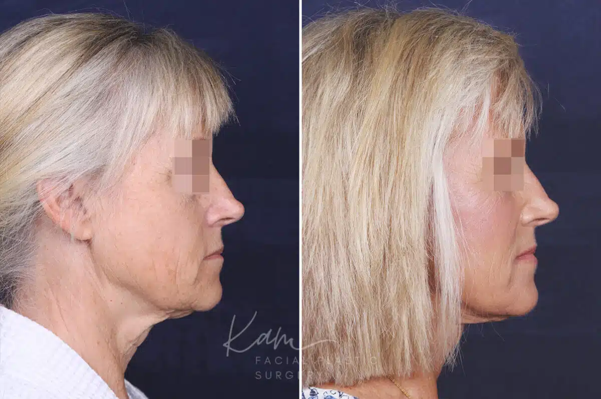 Facelift before and after photos in Voorhees, NJ, Patient 147