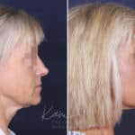 Facelift before and after photos in Voorhees, NJ, Patient 147