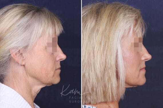 Facelift before and after photos in Voorhees, NJ, Patient 147
