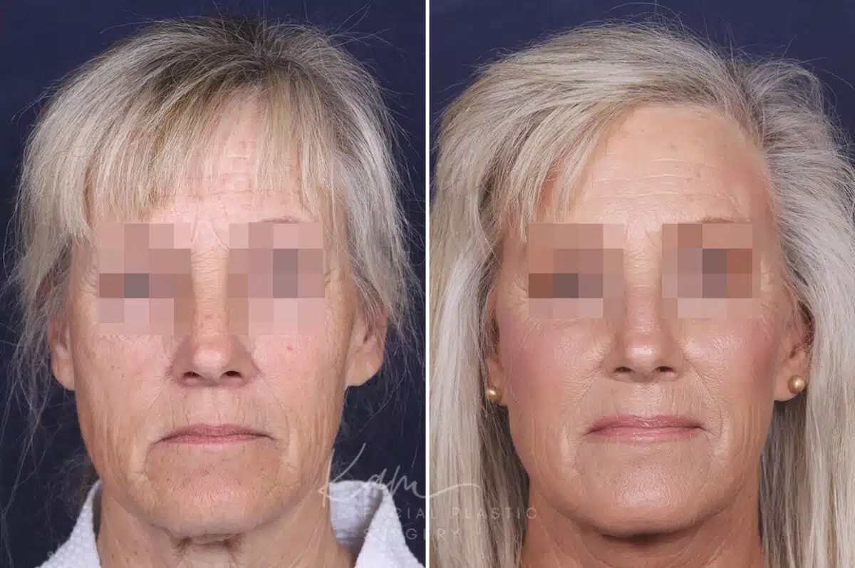 Facelift before and after photos in Voorhees, NJ, Patient 147