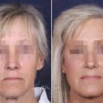 Facelift before and after photos in Voorhees, NJ, Patient 147