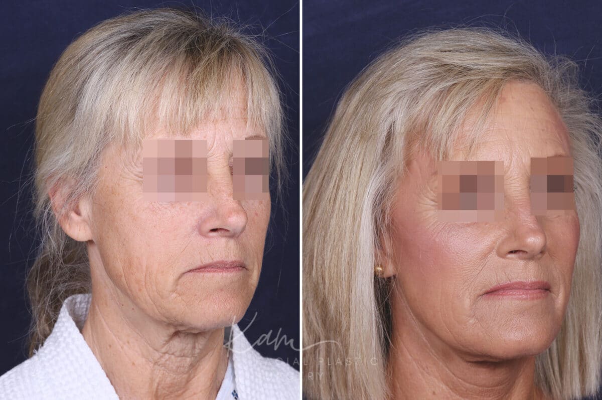 Facelift before and after photos in Voorhees, NJ, Patient 147