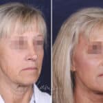 Facelift before and after photos in Voorhees, NJ, Patient 147