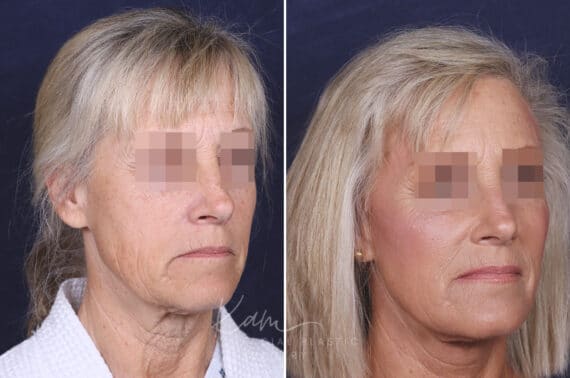 Facelift before and after photos in Voorhees, NJ, Patient 147