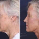 Facelift before and after photos in Voorhees, NJ, Patient 147
