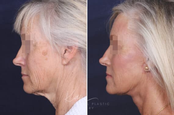 Facelift before and after photos in Voorhees, NJ, Patient 147