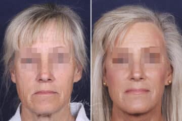 Facelift before and after photos in Voorhees, NJ, Patient 147