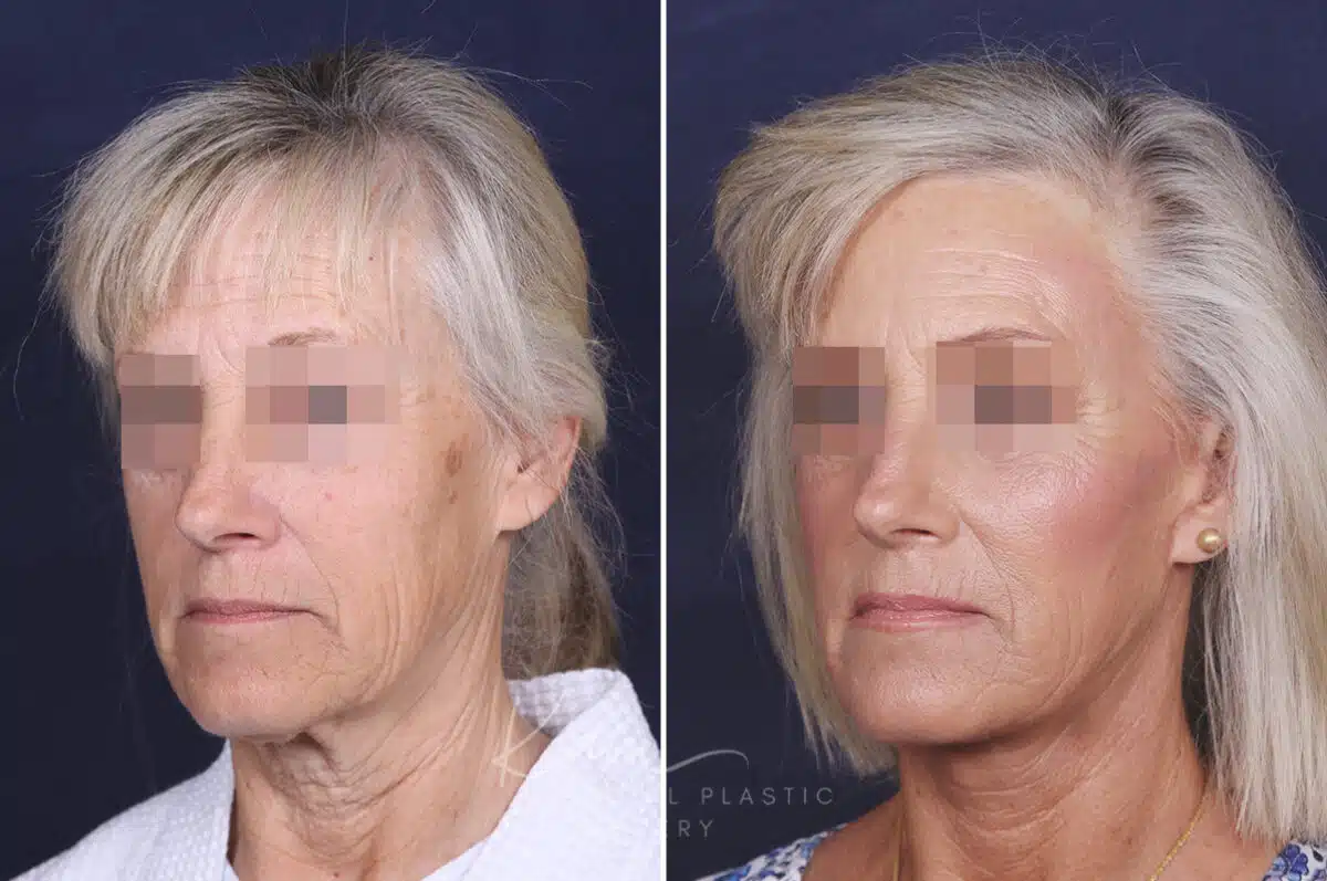 Facelift before and after photos in Voorhees, NJ, Patient 147
