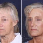 Facelift before and after photos in Voorhees, NJ, Patient 147
