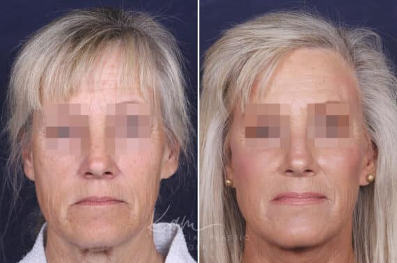 Facelift before and after photos in Voorhees, NJ, Patient 147