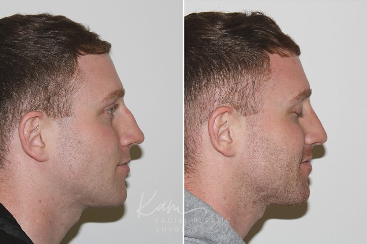 Rhinoplasty before and after photos in Voorhees, NJ, Patient 165