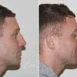Rhinoplasty before and after photos in Voorhees, NJ, Patient 165