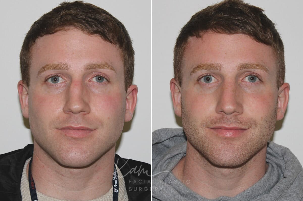 Rhinoplasty before and after photos in Voorhees, NJ, Patient 165