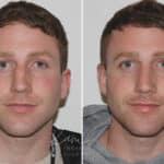 Rhinoplasty before and after photos in Voorhees, NJ, Patient 165