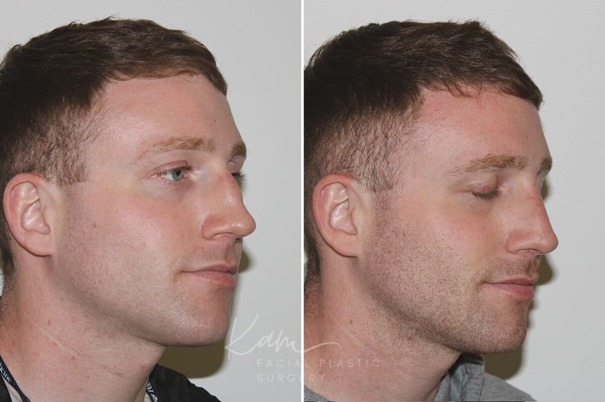 Rhinoplasty before and after photos in Voorhees, NJ, Patient 165