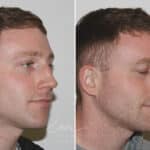 Rhinoplasty before and after photos in Voorhees, NJ, Patient 165