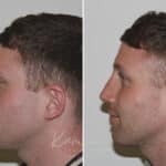 Rhinoplasty before and after photos in Voorhees, NJ, Patient 165
