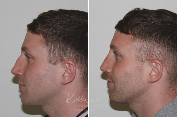 Rhinoplasty before and after photos in Voorhees, NJ, Patient 165