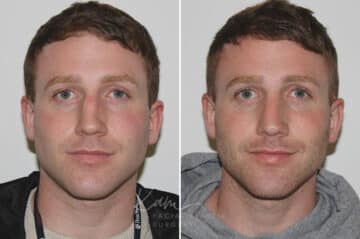 Rhinoplasty before and after photos in Voorhees, NJ, Patient 165