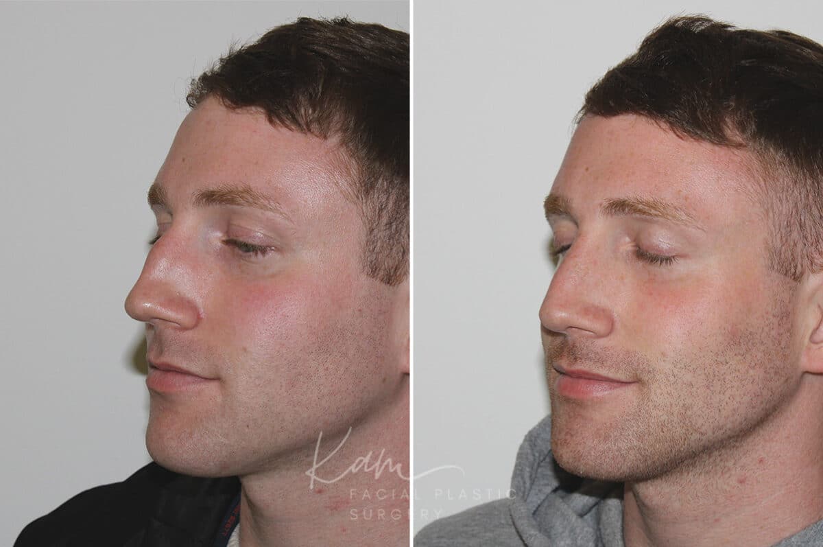 Rhinoplasty before and after photos in Voorhees, NJ, Patient 165