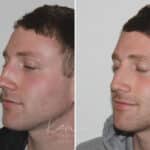 Rhinoplasty before and after photos in Voorhees, NJ, Patient 165