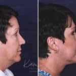 Facelift before and after photos in Voorhees, NJ, Patient 433