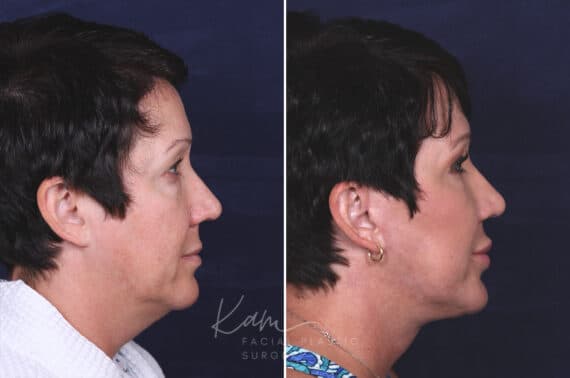 Facelift before and after photos in Voorhees, NJ, Patient 433