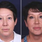 Facelift before and after photos in Voorhees, NJ, Patient 433